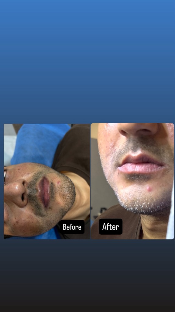 Acne Treatment Before and After - Patient 1