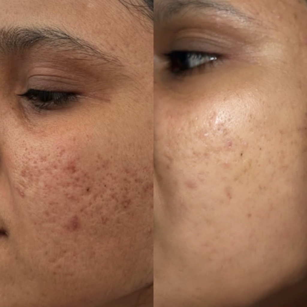 Acne Treatment Before and After - Patient 2
