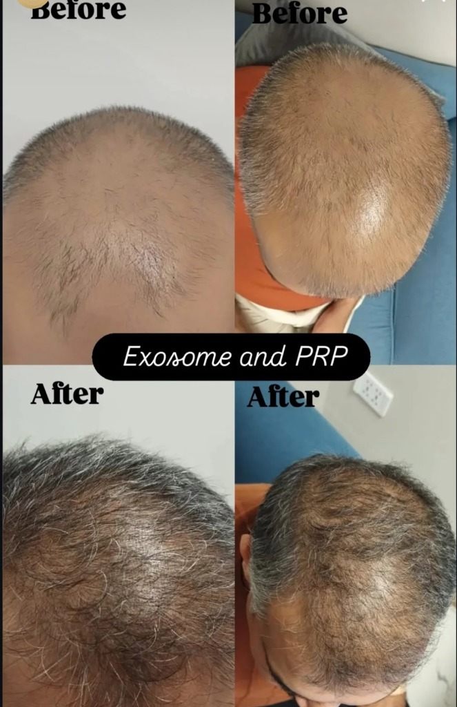 Exosome and PRP Hair Therapy Before and After