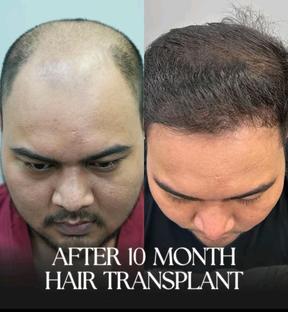 Hair Transplant Before and After
