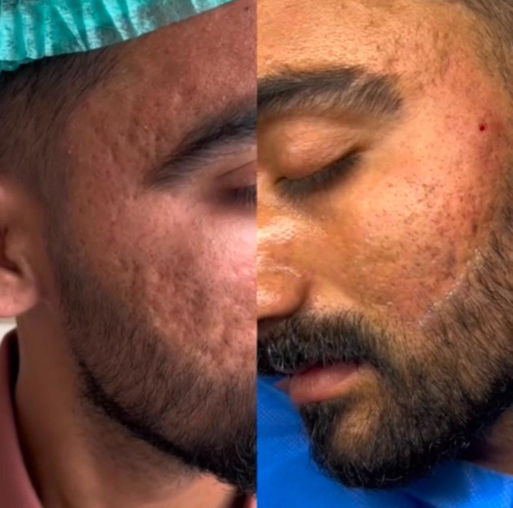 Acne Scar Subcision Transformation Before and After by Dr. Farah